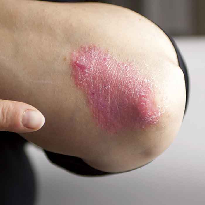 psoriase