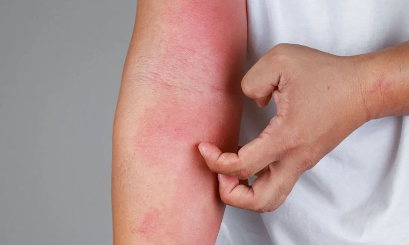 dermatite-atopica-medicacao