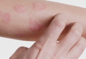dermatite-atopica