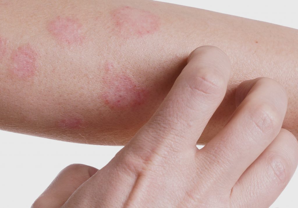 dermatite-atopica